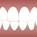 Does Laser Teeth Whitening Work?